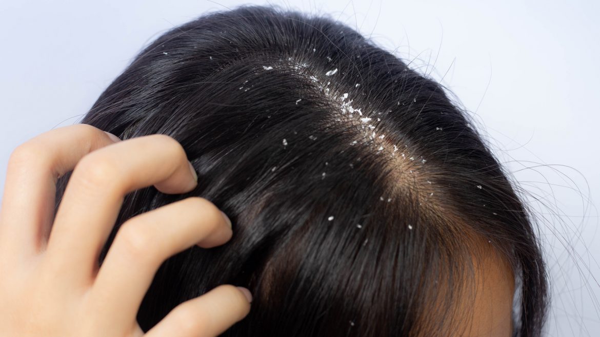 What is Dandruff? Causes & Treatments To Get Rid Of It ASAP